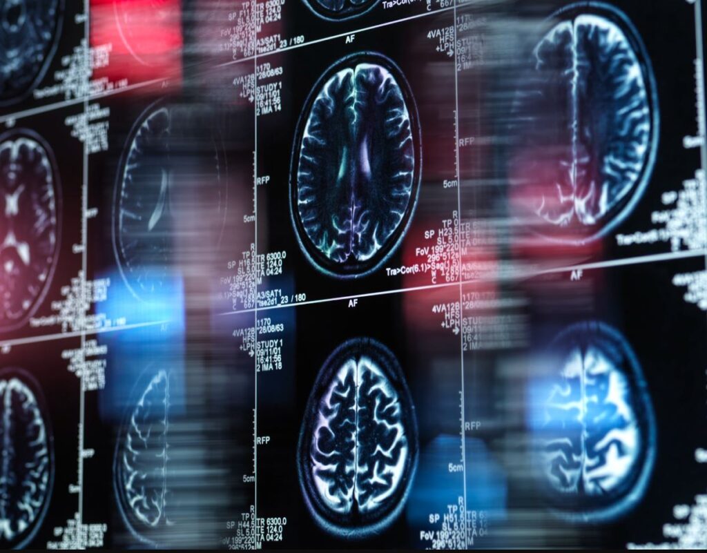 Photo of cat scans of a human brain