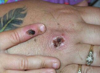 Photo of M-Pox Lesions on a patients hand